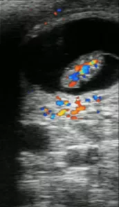 Fetus_CFM-on-ESG